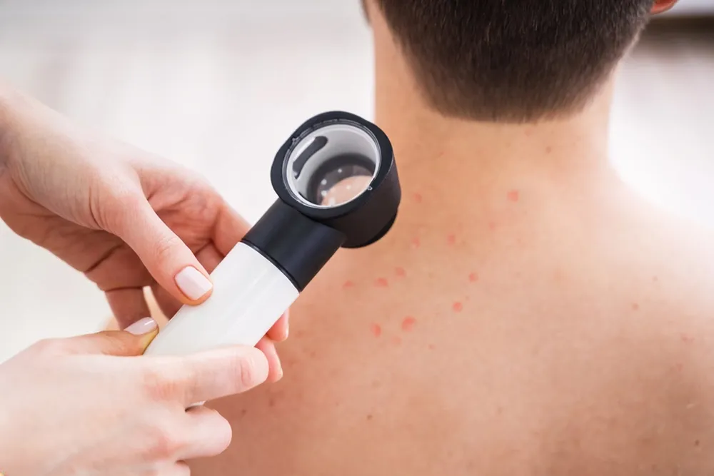 Ärztliche Untersuchung einer Hautstelle mit einem Dermatoskop zur Beurteilung einer Psoriasis.